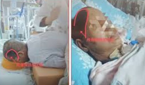 获救身首离断患者已脱离呼吸机半月并伴有重要血管神经损伤。